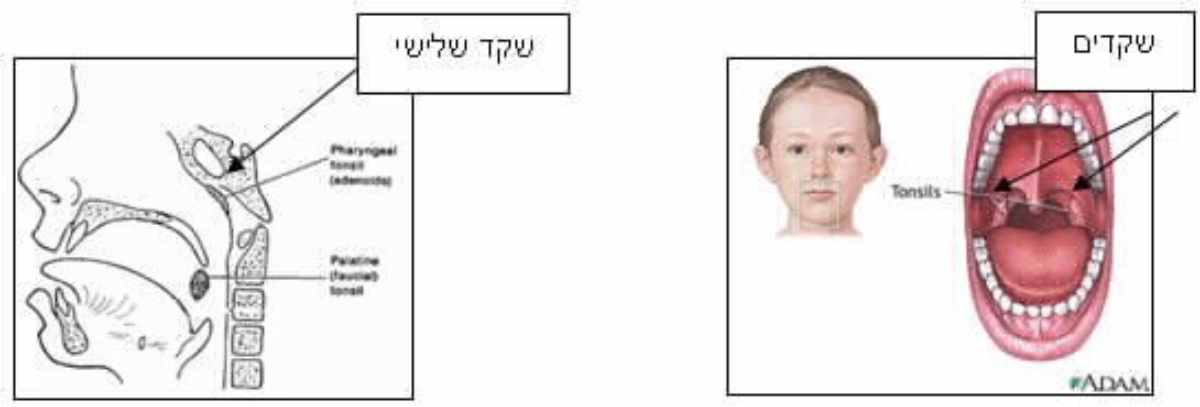 שקדים ושקד שלישי בילדים – תרשים להמחשת ניתוחי שקדים